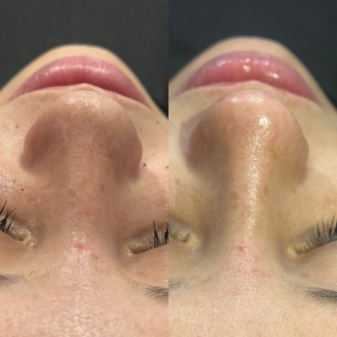 Limpieza facial profunda — MAG__estetica